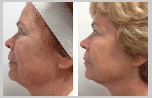 INFINIskin – Commonly called a Non-Surgical Facelift