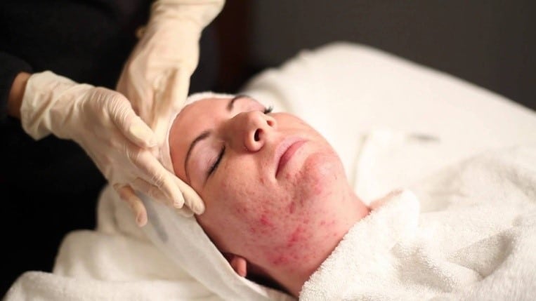 ACNE EXTRACTIONS COSMETIC DERMATOLOGIST CHARLESTON SC A 1