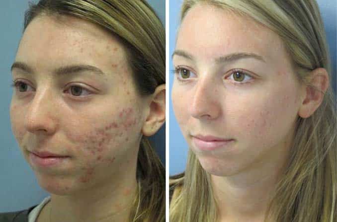 ACNE EXTRACTIONS COSMETIC DERMATOLOGIST CHARLESTON SC A 2