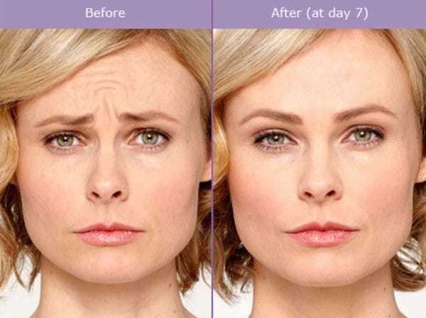 FROWN LINES COSMETIC DERMATOLOGIST CHARLESTON SC A