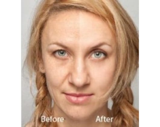 Our Hollywood Laser Peel