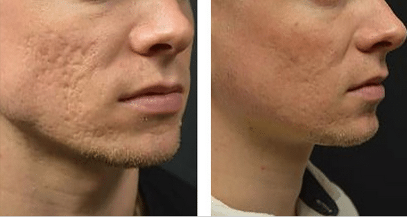 The INFINI Laser Treats Acne Scars and More