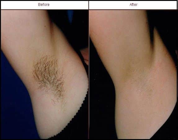 UNWANTED HAIR COSMETIC DERMATOLOGIST CHARLESTON SC A