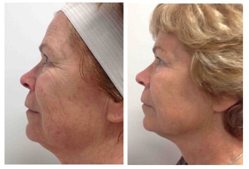 WRINKLES AND SKIN LAXITY COSMETIC DERMATOLOGIST CHARLESTON SC A