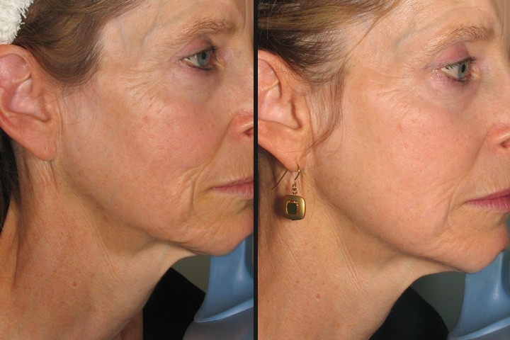 WRINKLES AND SKIN LAXITY COSMETIC DERMATOLOGIST CHARLESTON SC D