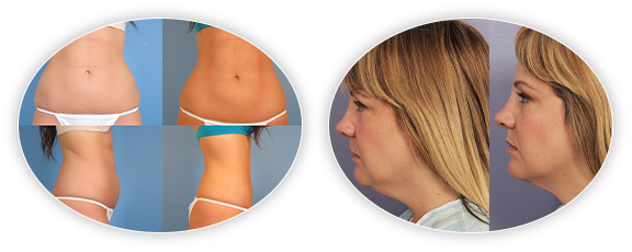  CoolSculpting Clinic Hollywood, SC